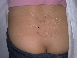 腰部针灸图片,腰部穴位精准定位与治疗技巧